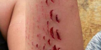 Una mujer de 38 años fue mordida por un tiburón cuando nadaba en Gran Canaria