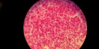 El Centro Nacional de Epidemiología alerta de un aumento de casos de gonorrea, con 182 en Canarias