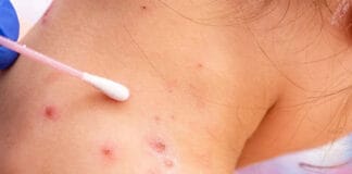 Sanidad registra hoy dos nuevos positivos y notifica seis nuevos casos para estudio de viruela del mono