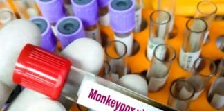 Sanidad registra cuatro casos positivos y notifica tres sospechas para estudio de viruela del mono desde el viernes pasado