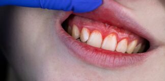 ¿Qué es la periodontitis y cuáles son los tratamientos?